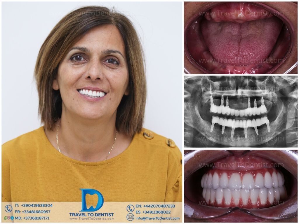 Caso clínico 5 - Resultado dental