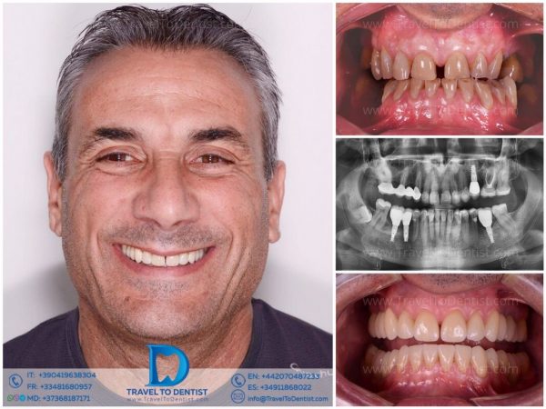 Caso clínico 2 - Resultado dental